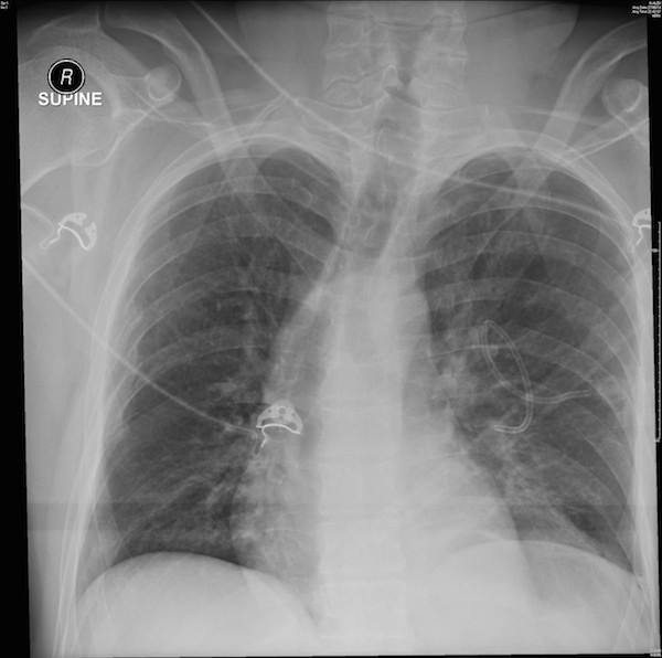 Chest X-ray 1 on arrival