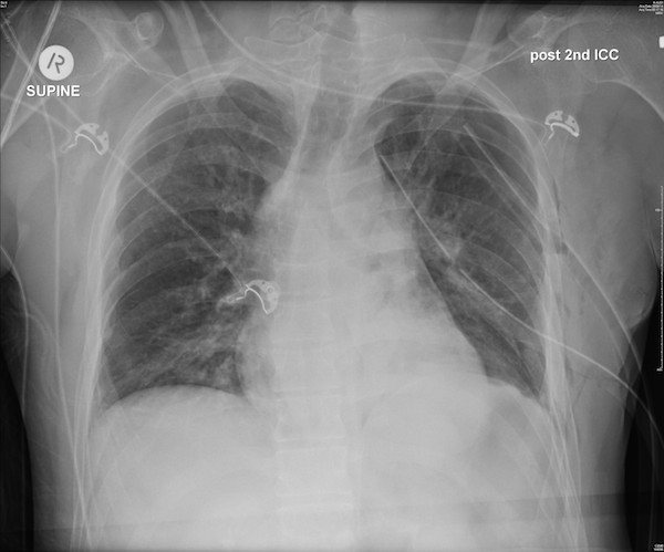 Post 2nd chest tube insertion